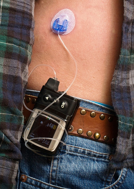 Insulin Pumps are More Effective in Controlling Blood Glucose Levels in ...