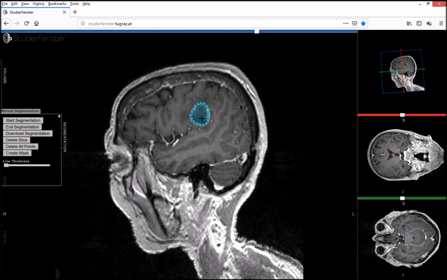 46-year-old-man-s-routine-eye-test-results-in-a-golf-ball-sized-tumor